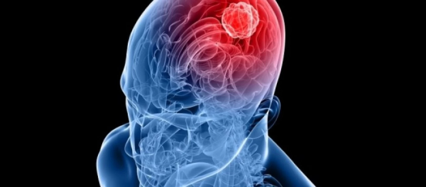 Μηνιγγίωμα στο κεφάλι: Το νου σας σε αυτά τα συμπτώματα - Το θα νιώσετε